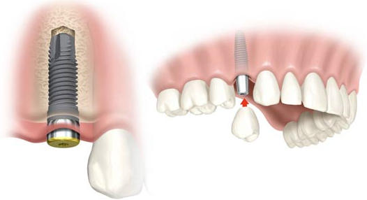 Implantes dentales - Urgencias Dentales Mallorca