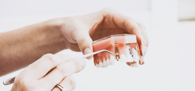 Implantes dentales Photo by Peter Kasprzyk on Unsplash