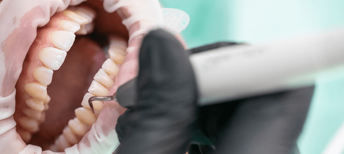 Enfermedad periodontal, en que consiste y cuales son los riesgos para la salud