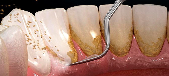 Diferencias entre limpieza dental y curetaje