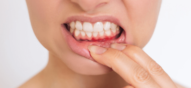 ¿Es contagiosa la gingivitis?