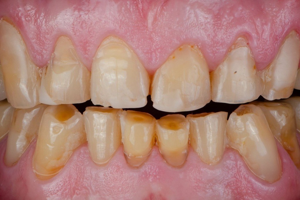 Causas del desgaste dental