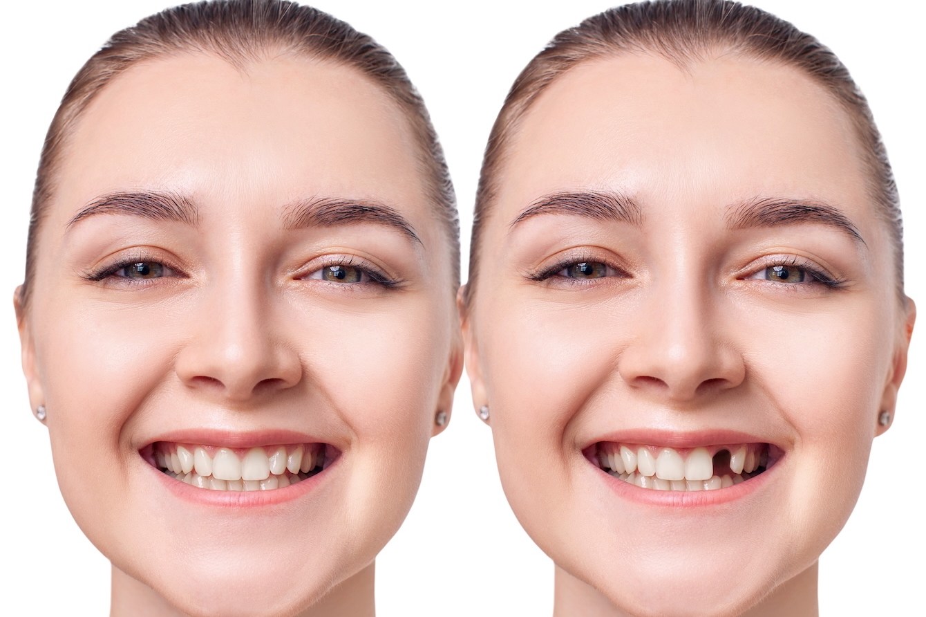 La Prostodoncia- Restaurando sonrisas y funciones