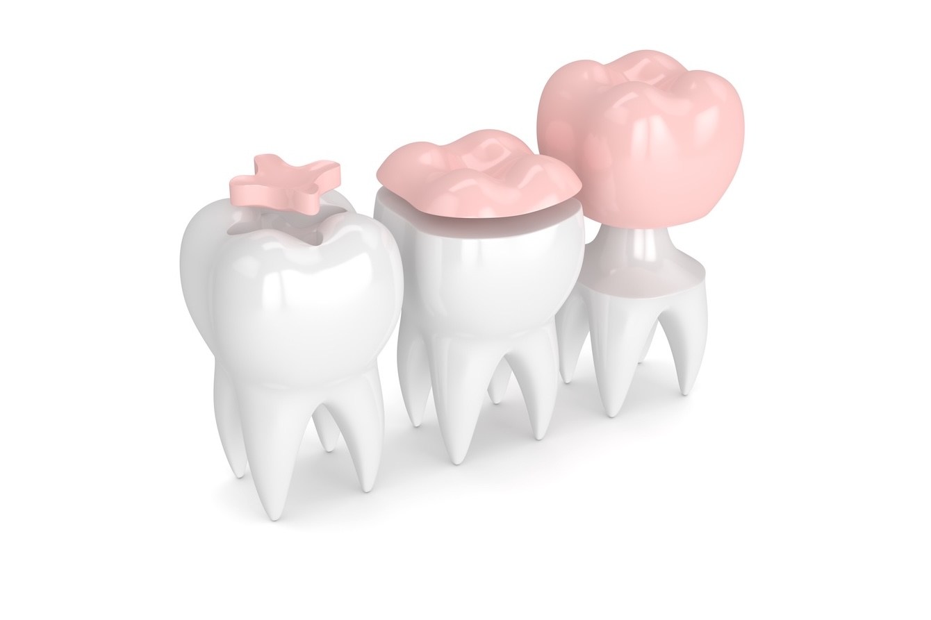 Odontología biomimética. Imitando a la naturaleza para una sonrisa duradera